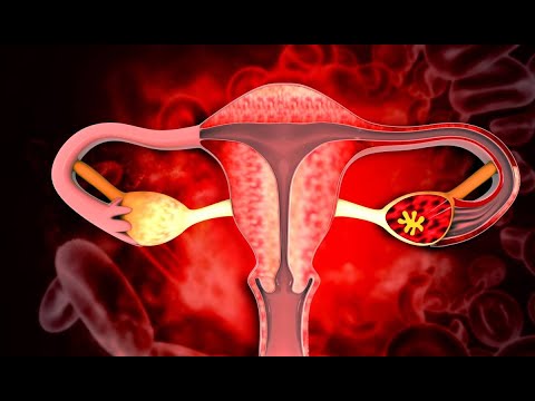 Fibromul uterin, de la simptomatologie, la diagnostic. „Apare ,de obicei, sub vârsta de 50 de ani”