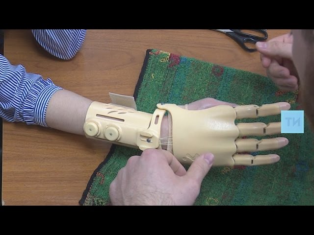 Потерявшей руку студентке из Челнов установили уникальный протез