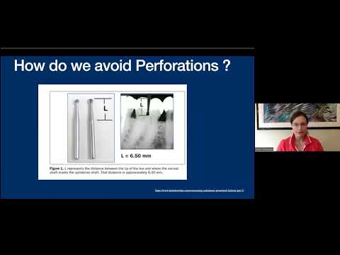 Stop Perforating Perfect Endo Access In 60s