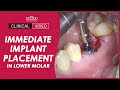 Immediate implant placement in lower molar