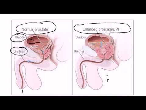 7 táblázat: diéta prosztatitis