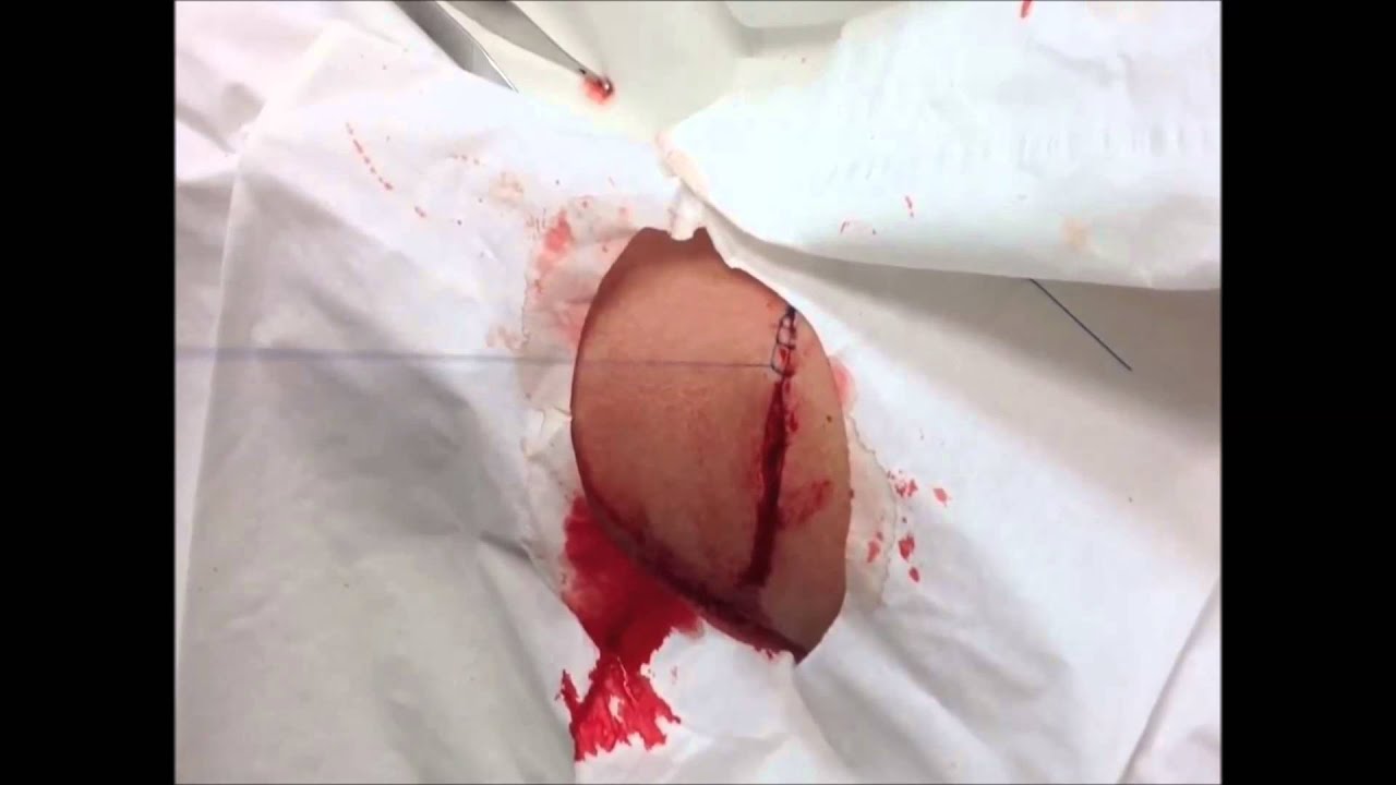 Sutura de laceração em braço