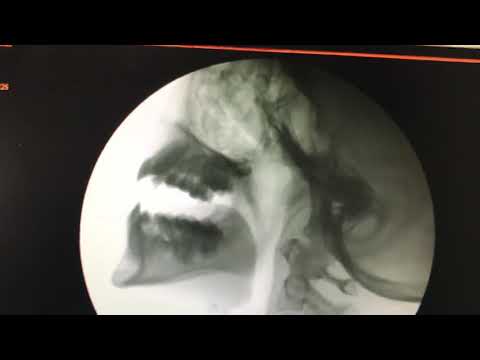 Lateral video fluoroscopy in a cath lab for a patient with VPI for Speech Surgery