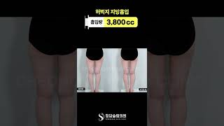 허벅지부터 무릎살까지 싹 다 정리해버림🧹