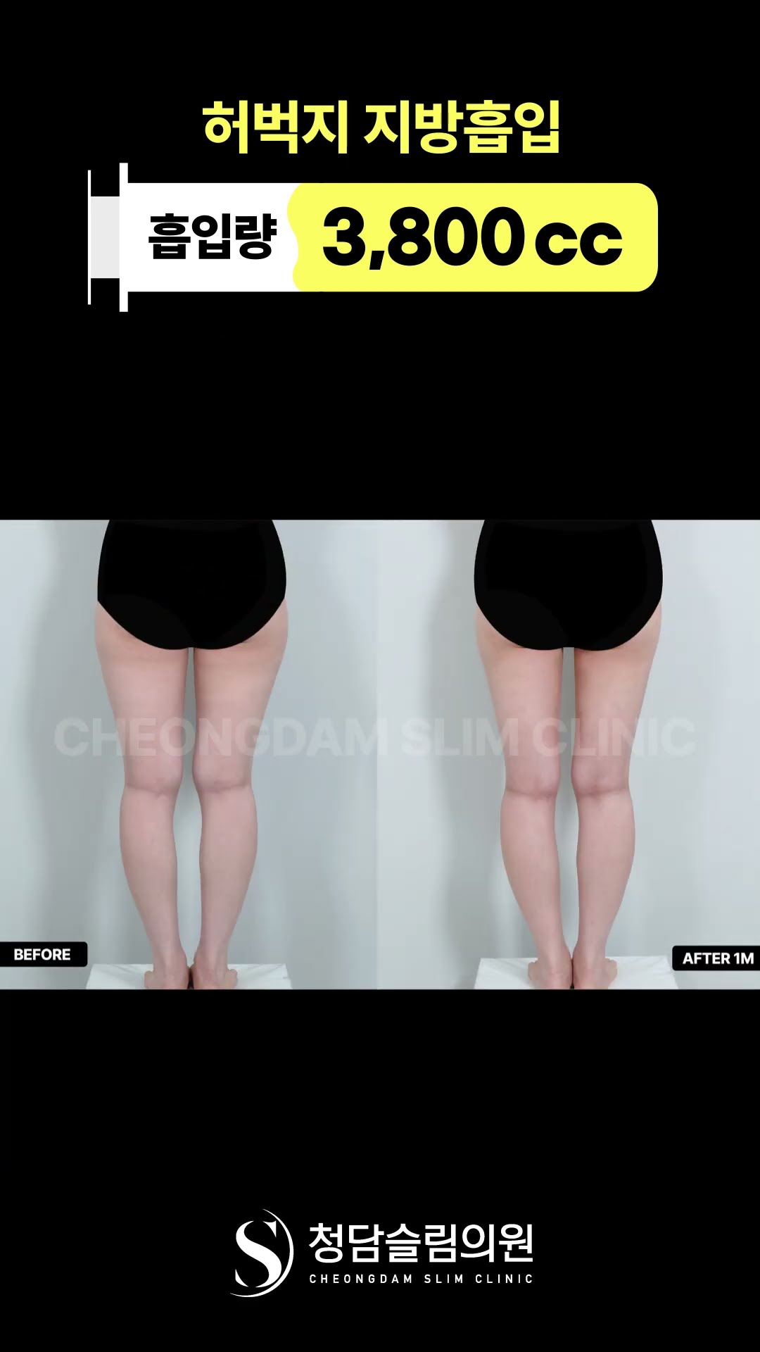 허벅지부터 무릎살까지 싹 다 정리해버림🧹