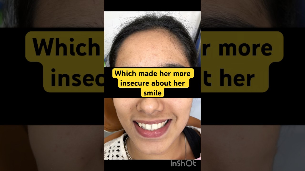 Minor alignment correction done using metal brackets