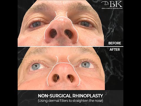 Matt's Non-Surgical Rhinoplasty Matt's Non-Surgical Rhinoplasty
