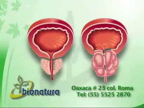 Compresse trattamento prostatite candele Come convincere il marito a massaggio prostatico