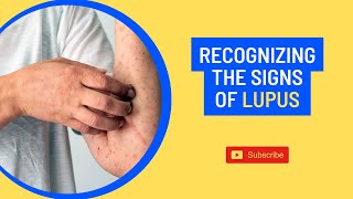Unveiling lupus Recognizing the signs and symptoms