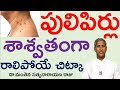 పులిపిర్లు శాశ్వతంగా రాలిపోవాలంటే Home