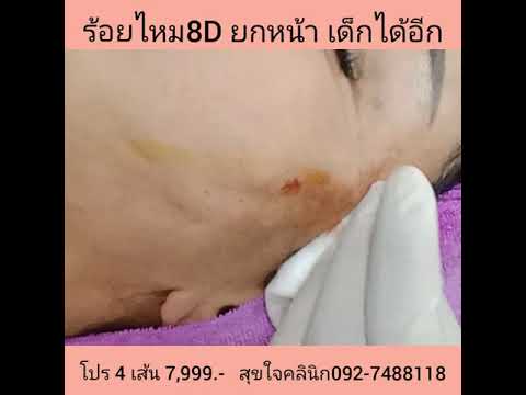 ร้อยไหม หน้าเรียว