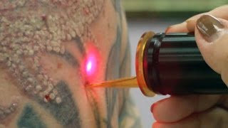 Laser Tattoo Removal - How a Tattoo is Removed