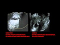 HISTEROSONO Wmv