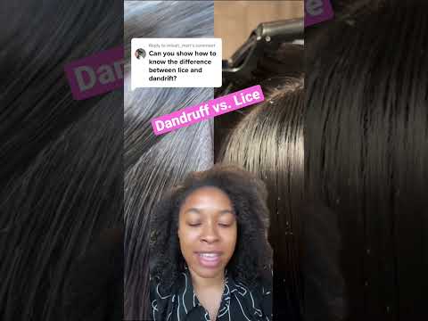 Dandruff vs Lice: What is the difference 🤔 l Lice Removal Service @staceythelouselady