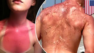 Why you should wear sunscreen: This is how the sun’s harmful UV rays damage your skin - TomoNews