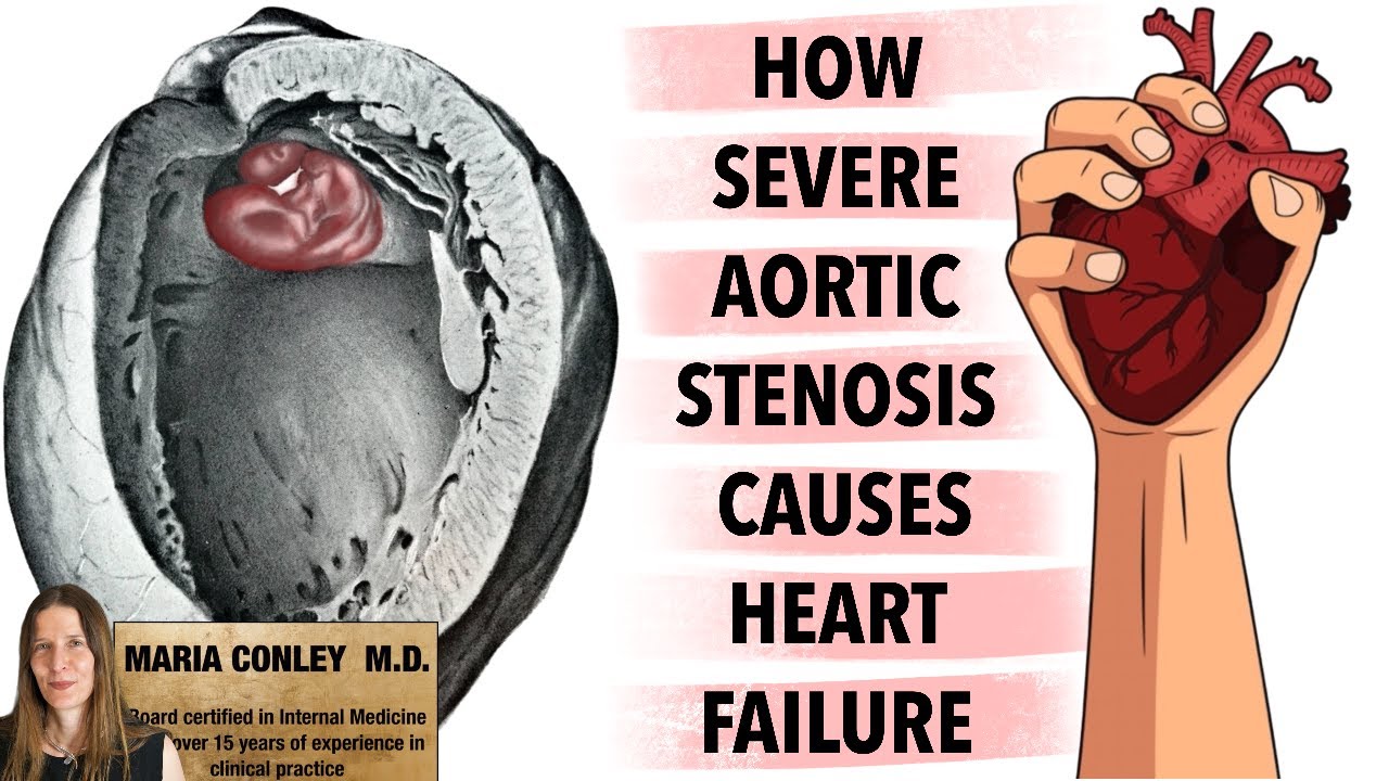 How Severe Aortic Stenosis Causes Heart Failure