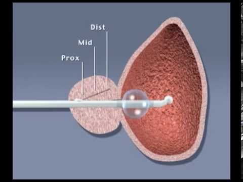 Prostata-Probleme Prostatitis und die Auswirkungen auf eine Frau