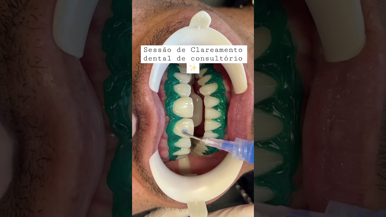Pronto para clarear ✨ #dentistas #dentes #odontologia #odonto #clareamentodental #clareamento