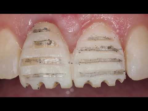 Porcelain Veneer -  Preparation through the mock up