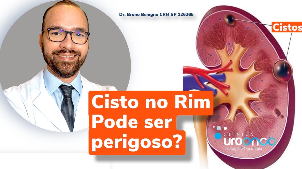 Cisto no Rim é perigoso Quando tratar Uro-oncologista explica.