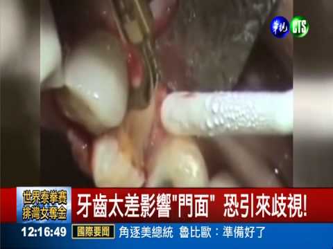 有"齒"一說! 一口爛牙會找嘸工作