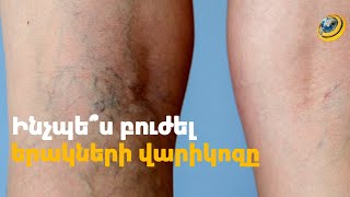 Ինչպե՞ս բուժել երակների վարիկոզը