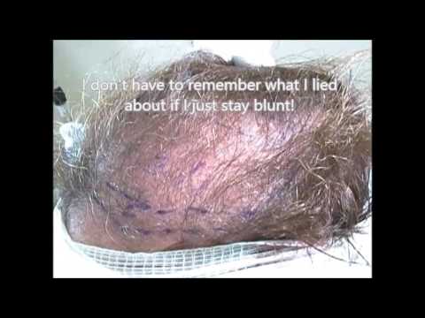 Ohio lady travels to Virginia for Hair restoration with Dr. Lindsey | McLean | VA | Maryland thumbnail