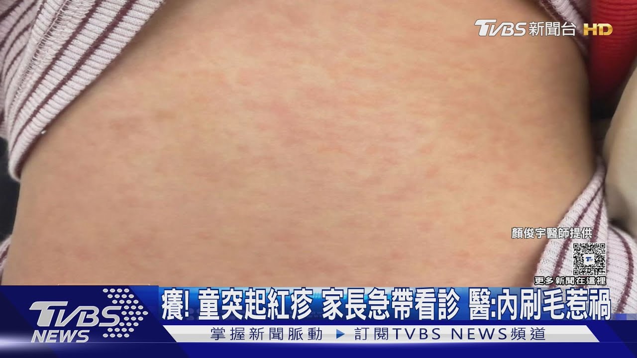 家長急！幼稚園童背狂起疹 醫揪「這材質」恐變皮膚災難