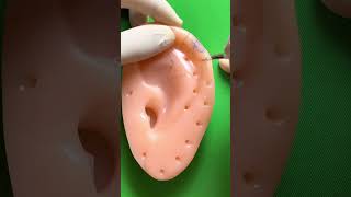 Download lagu Ear cancer excision and repair (part 1) mp3