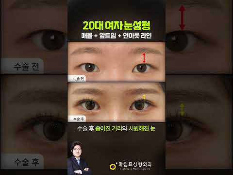 20대 여성의 매몰 + 앞트임 변화 · 韩语