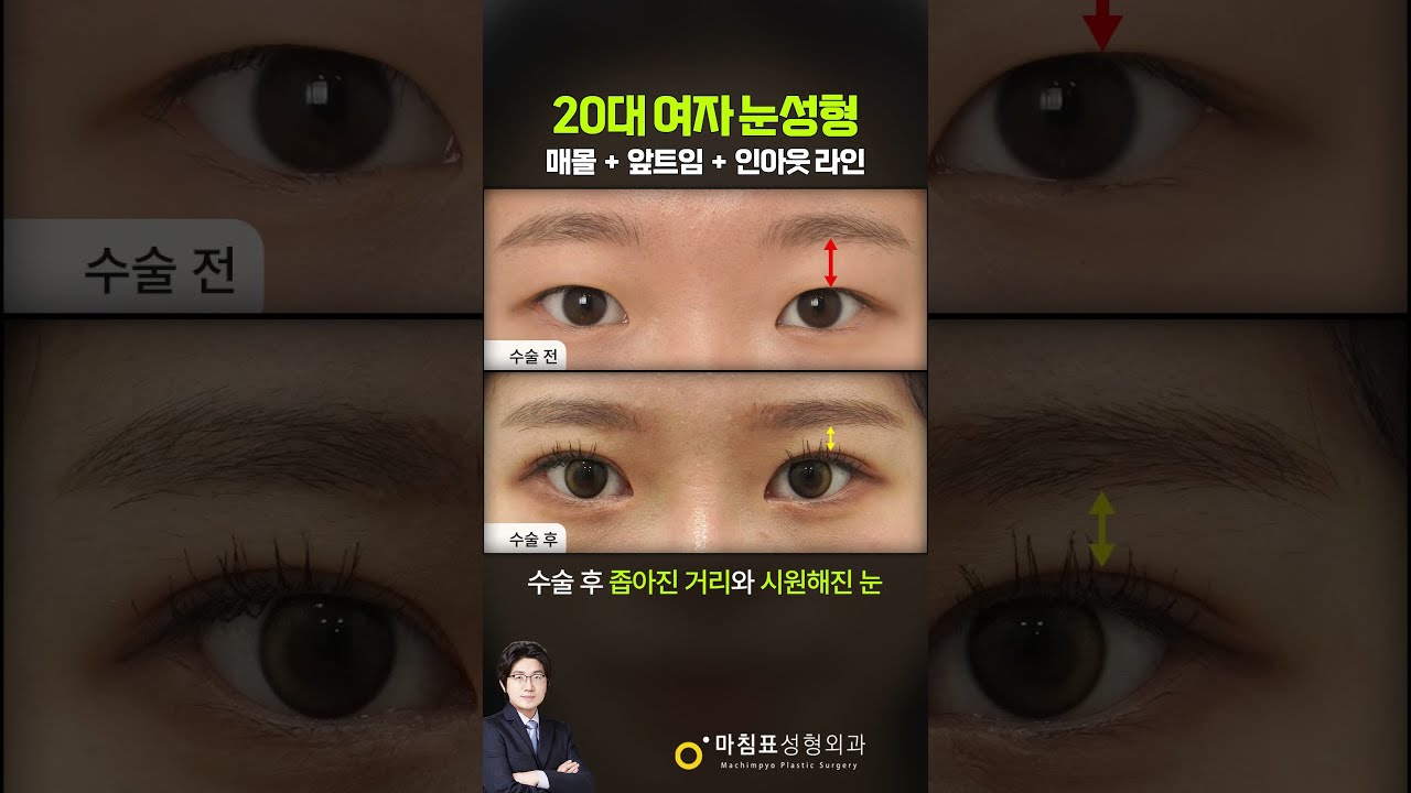 20대 여성의 매몰 + 앞트임 변화 썸네일 — 마침표성형외과 눈성형 영상