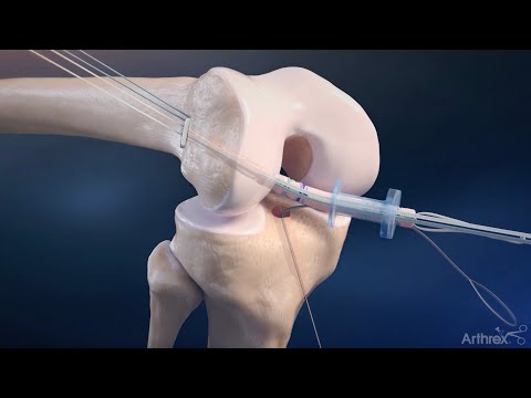 QuadLink All-inside ACLR using FiberTag TightRope II implants and the InternalBrace technique
