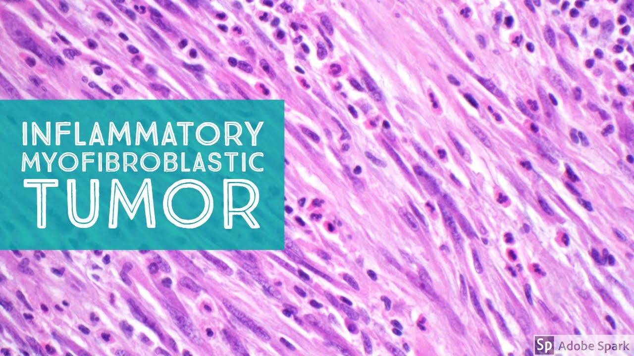 IMT: Inflammatory Myofibroblastic Tumor...Explained by a Soft Tissue Pathologist