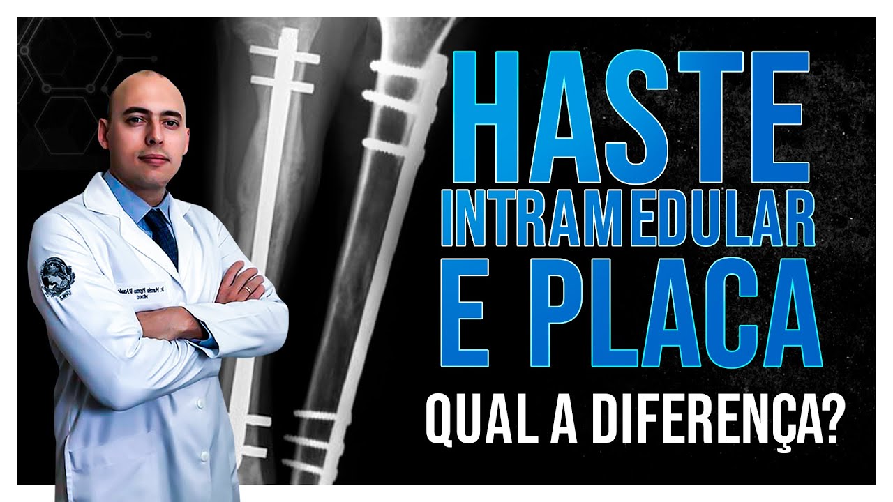 CIRURGIA ORTOPÉDICA | QUAL A DIFERENÇA ENTRE A HASTE INTRAMEDULAR E A PLACA?
