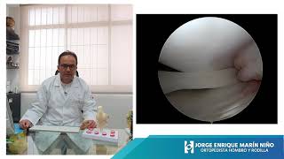 Lesión meniscal tipo asa de balde
