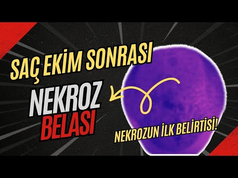 Saç Ekiminden Sonra Nekroz Belirtileri Neler? - Dr. Hamid Aydın #saçekimi