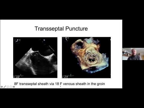 Paravalvular leak closure : indications, techniques and outcomes | H. Sievert (Allemagne)
