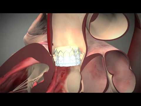 Understanding TAVR Surgery