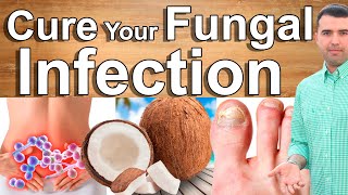 Eliminate Fungal Infections With These Home Remedies - Say Goodbye Digestive, Skin Fungal Infections