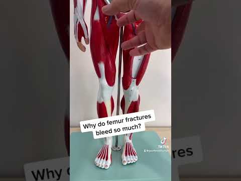 Why do femur fractures bleed so much