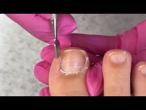 Toenail Transformation (Complete Step by Step)