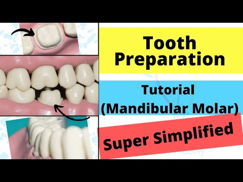 Mandibular Molar Crown Preparation Demonstration!!