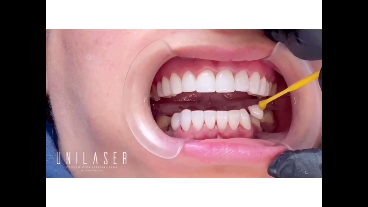 Unilaser | Diseño de sonrisa y coronas sobre dientes