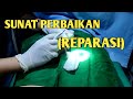 Sunat Perbaikan Reparasi Sunat Dewasa By NASTYON Khitan Center
