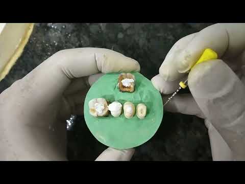 HOW TO DO RCT USING ENDOMOTOR