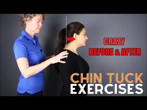 Chin Tuck Exercise - Before and After text neck