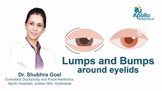 Lumps & Bumps around Eyelids | Dr. Shubhra Goel | Apollo Hospital |