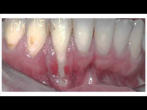 Hablando de Salud Oral 05-28-15 (03) - Contestando los Textos sobre las Encías