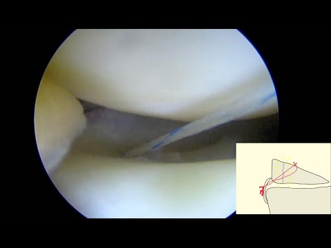Ortho Skipass - artroskopowe szycie łąkotki