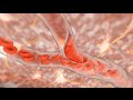 Ischemic Stroke